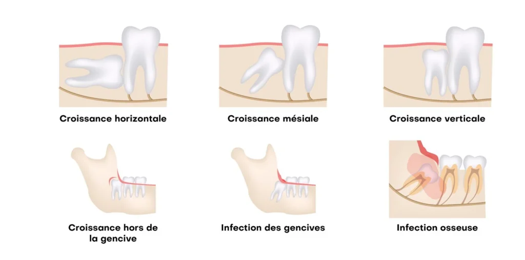 Dégagement des dents incluses