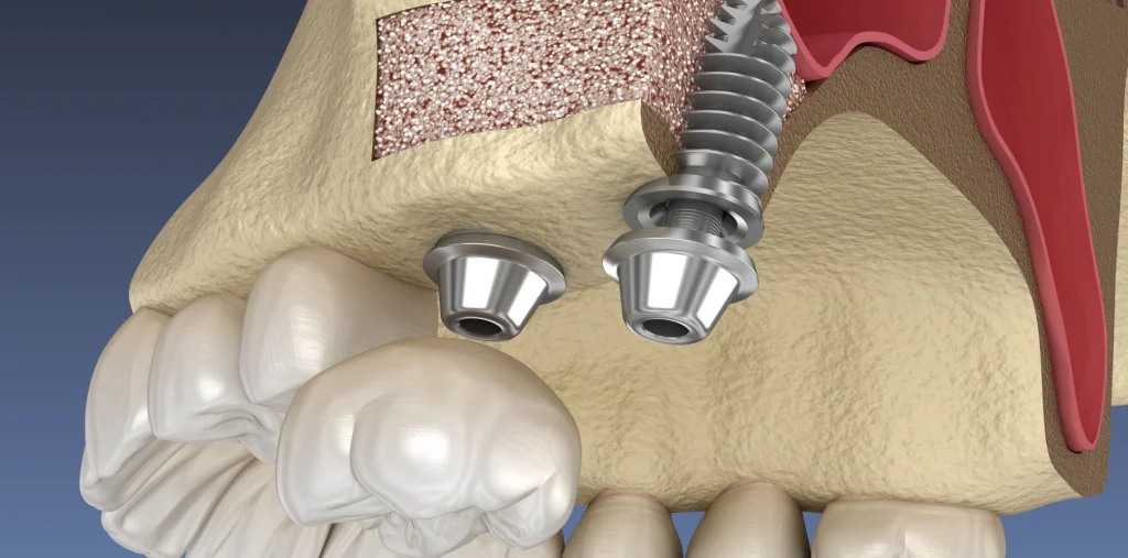 Conseils sinus lift